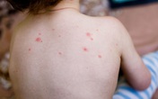 Làm gì để tránh biến chứng khi mắc thủy đậu (bệnh lây qua đường hô hấp) trong mùa COVID-19? Làm gì để tránh biến chứng khi mắc thủy đậu (bệnh lây qua đường hô hấp) trong mùa COVID-19?