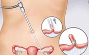 Nga Phụ Khang – Chìa khóa “vàng” giúp cải thiện u xơ tử cung, u nang buồng trứng Nga Phụ Khang – Chìa khóa “vàng” giúp cải thiện u xơ tử cung, u nang buồng trứng
