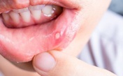Nhiệt miệng, vì sao? Nhiệt miệng, vì sao?
