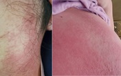 Phát hoảng với những cách làm đẹp sau sinh dễ gặp biến chứng Phát hoảng với những cách làm đẹp sau sinh dễ gặp biến chứng