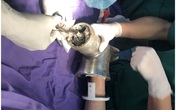 Bất cẩn trong lúc xay thịt, người phụ nữ bị cuốn cả bàn tay vào máy Bất cẩn trong lúc xay thịt, người phụ nữ bị cuốn cả bàn tay vào máy