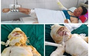 Chồng mất, 3 mẹ con bị bỏng nặng sau vụ cháy điều hòa đang rất cần sự giúp đỡ Chồng mất, 3 mẹ con bị bỏng nặng sau vụ cháy điều hòa đang rất cần sự giúp đỡ