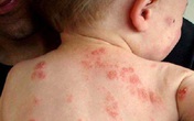 Mẹ bầu chủ quan có thể khiến con mắc bệnh hiếm gặp từ trong bụng mẹ Mẹ bầu chủ quan có thể khiến con mắc bệnh hiếm gặp từ trong bụng mẹ