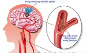Giải pháp hỗ trợ giảm nguy cơ tai biến cho người cao huyết áp Giải pháp hỗ trợ giảm nguy cơ tai biến cho người cao huyết áp
