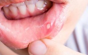 Viêm loét khoang miệng, nhiệt lưỡi, nhiệt miệng, nhiệt lợi, nhiệt miệng áp tơ đau xót không ăn uống được: dùng ngay gel bôi thảo dược Gumimouth Viêm loét khoang miệng, nhiệt lưỡi, nhiệt miệng, nhiệt lợi, nhiệt miệng áp tơ đau xót không ăn uống được: dùng ngay gel bôi thảo dược Gumimouth