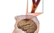 Tại sao hàng triệu người bị đột quỵ nhồi máu não dùng Nattospes hiệu quả? Tại sao hàng triệu người bị đột quỵ nhồi máu não dùng Nattospes hiệu quả?