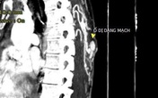 Tưởng mụn hóa búi dị dạng động tĩnh mạch Tưởng mụn hóa búi dị dạng động tĩnh mạch