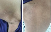 Độc tố loại khuẩn thường gặp khiến bé 5 tuổi ửng đỏ, không điều trị kịp có thể tử vong Độc tố loại khuẩn thường gặp khiến bé 5 tuổi ửng đỏ, không điều trị kịp có thể tử vong