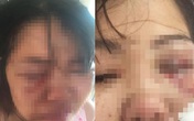 Chỉ vì muốn ly hôn, người phụ nữ bị chồng đánh đập dã man Chỉ vì muốn ly hôn, người phụ nữ bị chồng đánh đập dã man