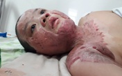 Sẹo co kéo khiến cậu bé bị bỏng xăng không thể quay nổi đầu Sẹo co kéo khiến cậu bé bị bỏng xăng không thể quay nổi đầu