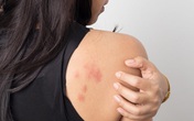 Những vết mẩn đỏ cảnh báo căn bệnh ung thư phổ biến Những vết mẩn đỏ cảnh báo căn bệnh ung thư phổ biến