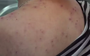 Bác sĩ dùng nhíp loại bỏ hơn 400 ngòi ong châm trên cơ thể bệnh nhân Bác sĩ dùng nhíp loại bỏ hơn 400 ngòi ong châm trên cơ thể bệnh nhân