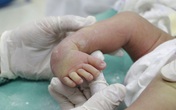 Phục hồi bàn chân cho bé trai bị khoèo bẩm sinh Phục hồi bàn chân cho bé trai bị khoèo bẩm sinh