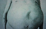 Chuyện kỳ lạ về người đàn ông bị táo bón bẩm sinh, chết khi cố đi đại tiện và ruột già được trưng bày trong bảo tàng Mỹ gây "sởn da gà" Chuyện kỳ lạ về người đàn ông bị táo bón bẩm sinh, chết khi cố đi đại tiện và ruột già được trưng bày trong bảo tàng Mỹ gây "sởn da gà"