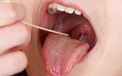 Ung thư lưỡi có thể phát hiện sớm? Ung thư lưỡi có thể phát hiện sớm?