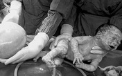 Một bé trong đôi song sinh chào đời nguyên bọc ối Một bé trong đôi song sinh chào đời nguyên bọc ối