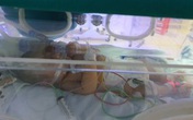 Bé 9 ngày tuổi nguy kịch do bị uốn ván Bé 9 ngày tuổi nguy kịch do bị uốn ván