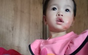 Hình ảnh mới của bé gái dân tộc bị bỏng nặng sau tai nạn ngã vào bếp lửa Hình ảnh mới của bé gái dân tộc bị bỏng nặng sau tai nạn ngã vào bếp lửa