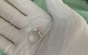 Bé gái 8 tuổi nuốt phải chiếc nhẫn của mẹ Bé gái 8 tuổi nuốt phải chiếc nhẫn của mẹ