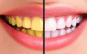 Ngạc nhiên với cách làm răng trắng bóng sạch đơn giản, rẻ tiền mà không phải dùng hóa chất Ngạc nhiên với cách làm răng trắng bóng sạch đơn giản, rẻ tiền mà không phải dùng hóa chất