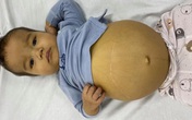 Người mẹ đơn thân chỉ biết nhìn con trai 11 tháng da vàng, bụng căng tròn như “trống” vì nghèo khó Người mẹ đơn thân chỉ biết nhìn con trai 11 tháng da vàng, bụng căng tròn như “trống” vì nghèo khó