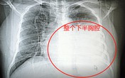 Ho khan lâu ngày, cô giáo giật mình phát hiện ung thư Ho khan lâu ngày, cô giáo giật mình phát hiện ung thư