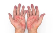 Mệt mỏi, da mẩn đỏ: Có thể virus đang tàn phá lá gan Mệt mỏi, da mẩn đỏ: Có thể virus đang tàn phá lá gan