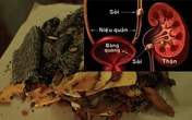 Chuyên gia Đông y giúp bạn điều trị sỏi tiết niệu nhờ bài thuốc bí truyền 150 năm Chuyên gia Đông y giúp bạn điều trị sỏi tiết niệu nhờ bài thuốc bí truyền 150 năm