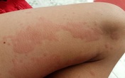 Nhiều người nổi mẩn ngứa "điên người", gãi đến toác da vào đầu hè, chuyên gia nói gì? Nhiều người nổi mẩn ngứa "điên người", gãi đến toác da vào đầu hè, chuyên gia nói gì?