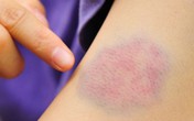 Xuất hiện vết bầm tím trên da, chuyên gia cảnh báo dấu hiệu cần đi khám sớm Xuất hiện vết bầm tím trên da, chuyên gia cảnh báo dấu hiệu cần đi khám sớm