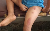 Bé trai bị cha dượng châm thuốc lá vào người Bé trai bị cha dượng châm thuốc lá vào người