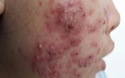 Tưởng mụn trứng cá hoá ra bệnh lần đầu nghe đến, thời gian chữa trị rất dài Tưởng mụn trứng cá hoá ra bệnh lần đầu nghe đến, thời gian chữa trị rất dài