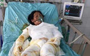 Chồng bị thần kinh, vợ đang nguy kịch vì bỏng nặng rất cần sự giúp đỡ