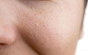 Note ngay cách cải thiện mụn trứng cá không viêm từ kem trị mụn thảo dược! Note ngay cách cải thiện mụn trứng cá không viêm từ kem trị mụn thảo dược!