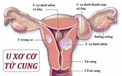 Cải thiện u xơ tử cung bằng sản phẩm thảo dược - Xu hướng mới được nhiều chị em lựa chọn Cải thiện u xơ tử cung bằng sản phẩm thảo dược - Xu hướng mới được nhiều chị em lựa chọn