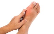 Giảm đau gút ở khớp ngón chân cái an toàn nhờ sản phẩm thảo dược Giảm đau gút ở khớp ngón chân cái an toàn nhờ sản phẩm thảo dược
