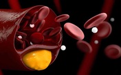 Sản phẩm thảo dược hạ mỡ máu: Xu hướng mới giúp giảm cholesterol, hỗ trợ điều trị mỡ máu cao an toàn, hiệu quả Sản phẩm thảo dược hạ mỡ máu: Xu hướng mới giúp giảm cholesterol, hỗ trợ điều trị mỡ máu cao an toàn, hiệu quả