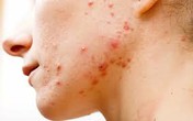 Cách chữa đơn giản bệnh viêm nang lông rất khó chữa, tốn tiền lại rất hay gặp bằng dược liệu Cách chữa đơn giản bệnh viêm nang lông rất khó chữa, tốn tiền lại rất hay gặp bằng dược liệu