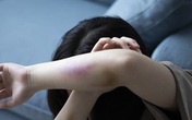 Cha về quê, con bị cô và dượng đánh đập tàn bạo Cha về quê, con bị cô và dượng đánh đập tàn bạo