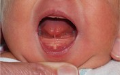 Nhận biết dính thắng lưỡi ở trẻ nhỏ Nhận biết dính thắng lưỡi ở trẻ nhỏ