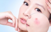 Mùa hè da dễ nổi mụn, vì sao? Mùa hè da dễ nổi mụn, vì sao?