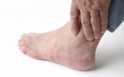 Biểu hiện khi bị gout như thế nào? Biểu hiện khi bị gout như thế nào?
