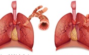 Bí quyết hỗ trợ long đờm, giảm ho, cải thiện khó thở do viêm phổi mạn tính từ thiên nhiên Bí quyết hỗ trợ long đờm, giảm ho, cải thiện khó thở do viêm phổi mạn tính từ thiên nhiên