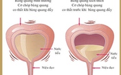 Viêm bàng quang – “cơn ác mộng” dẫn bạn đến nguy cơ vô sinh Viêm bàng quang – “cơn ác mộng” dẫn bạn đến nguy cơ vô sinh