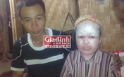 Mơ ước tương lai vô vọng của cậu bé "người cá" suýt bị dân bản chôn sống vì bệnh tật Mơ ước tương lai vô vọng của cậu bé "người cá" suýt bị dân bản chôn sống vì bệnh tật