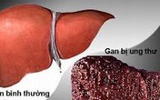 Hiểu tác nhân gây ung thư và xơ để có lá gan khỏe Hiểu tác nhân gây ung thư và xơ để có lá gan khỏe