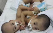 Sức khỏe hai bé được phẫu thuật tách rời đang dần ổn định Sức khỏe hai bé được phẫu thuật tách rời đang dần ổn định