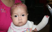 Nao lòng ánh mắt trong veo của bé 5 tháng tuổi bị rụng ngón, lở loét khắp cơ thể Nao lòng ánh mắt trong veo của bé 5 tháng tuổi bị rụng ngón, lở loét khắp cơ thể