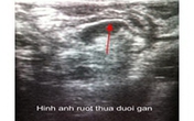 Cha mẹ chủ quan, bé 4 tuổi thủng ruột thừa Cha mẹ chủ quan, bé 4 tuổi thủng ruột thừa