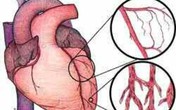 Bệnh viện Đa khoa tỉnh Thanh Hóa thực hiện thành công can thiệp tim mạch Bệnh viện Đa khoa tỉnh Thanh Hóa thực hiện thành công can thiệp tim mạch
